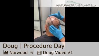 Norwood 6 Hair Transplant Procedure Day With Tons of Density  Dr Blumenthal Doug [upl. by Radford]