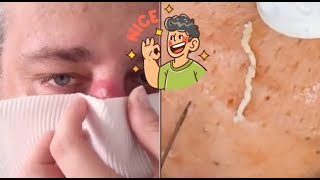 Ultimate Acne Pimple Popping Extractions Clear Skin Revealed [upl. by Kline144]