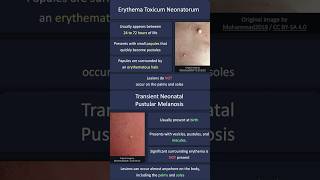 Erythema Toxicum Neonatorum vs Transient Neonatal Pustular Melanosis [upl. by Lebatsirhc265]