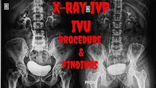 XRAY IVP  XRAY IVU Procedure Indications Findings  Intravenous Urogram  Intravenous Pyelogram [upl. by Gierc]