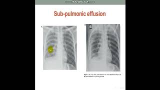 PleuralEffusionDiagnosticApproach [upl. by Dixil]