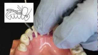 Ribbond Periodontal Splint Technique [upl. by Sherer]