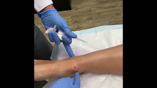 IntraArticular ankle injection [upl. by Muriel87]