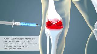 TLC599 Intraarticular Injection for Osteoarthritis Pain [upl. by Aittam590]