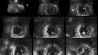 ACUTE MYOCARDIAL INFARCTION ANTEROSEPTAL 3D ECHOCARDIOGRAPHY cardiac ultrasound [upl. by Nyluqcaj]