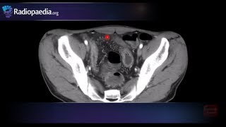 Comb sign of Crohns disease  radiology video tutorial CT [upl. by Gardie]