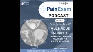 Multifidus Atrophy Multifidus Stimulation Peripheral Nerve Stimulation amp Leukocyte Rich PRP [upl. by Ecila]