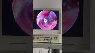 TTube Part3 hearingloss eardischarge tinnitus amazing [upl. by Aniroz]