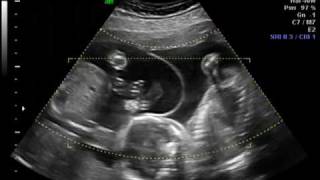 Ramos Twins  21 Weeks Ultrasound [upl. by Hares]