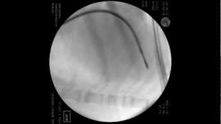 Endomyocardial biopsy in dog [upl. by Seabrooke300]