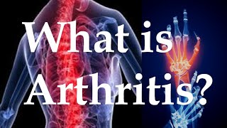 What is arthritis [upl. by Holder507]