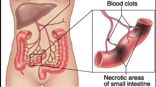 Mesenteric Ischemia [upl. by Irtimed]