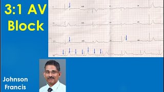 31 AV Block  ECG Quiz Discussion [upl. by Maag]