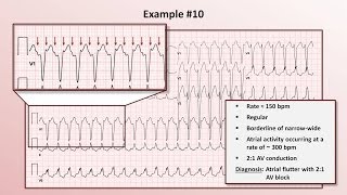 Intro to EKG Interpretation  Practicing Tachyarrhythmia Identification [upl. by Aray397]