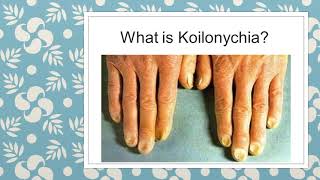 WHAT TO KNOW ABOUT KOILONYCHIA  NAIL DEFORMITIES  CLINICAL MEDICINE  MBBS REVISION GUIDE [upl. by Rockel680]