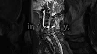 Narrow vs Open spinal canal Impact on Atlantoaxial instability shorts [upl. by Asenaj]