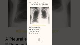 Chest XRay Buzz 7 radiologychannel007 [upl. by Giltzow]