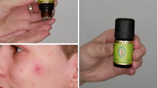 Can you apply Tea Tree Oil directly to Acne Pimple  Here is what happened to me [upl. by Gard]