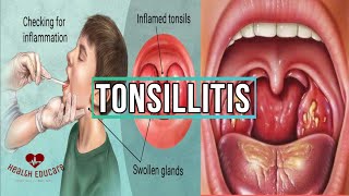 All you need to know about Tonsillitis [upl. by Musser]