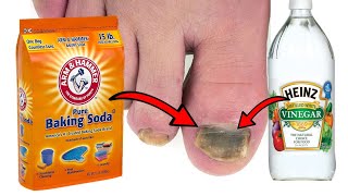 How To Get Rid of TOENAIL FUNGUS With Baking Soda amp Vinegar [upl. by Idola]