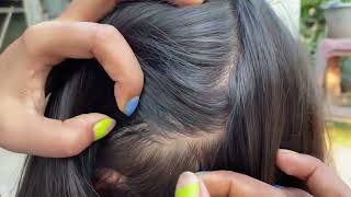 5 Mistakes Youre Making with Lice and Nits Removal [upl. by Emelun136]