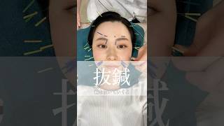 美容鍼抜鍼動画❤️美容鍼 aoはり治療院 [upl. by Otrebide]