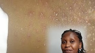 Eczema Products I Used To Treat Eczema In Kenya 🇰🇪 [upl. by Avalsorim]