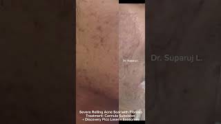 Severe Rolling Acne Scar Fibrosis Treatment Cannula Subcision  Discovery Pico Laser  Exosomes [upl. by Airalav]