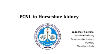 PCNL in Horseshoe Kidney [upl. by Mateusz]