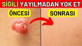 Siğilleri BİR GECEDE Yok Eden Doğal İlaç Siğiller Sağlığınız Hakkında Sizi Uyarıyor [upl. by Rich]