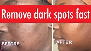 Dark Skin SKIN CARE  Aging  Dark Spots [upl. by Corette]