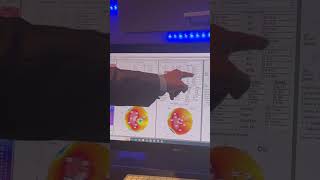 Failed Keratoconus Corneal Transplant Treatments GulaniVision [upl. by Wj]