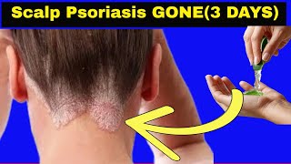 Cure Scalp Psoriasis in 3 Days Fast Itchy Scalp Relief [upl. by Skylar213]