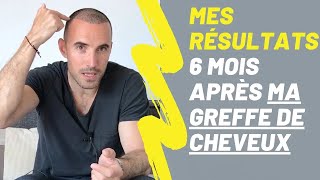 GREFFE DE CHEVEUX  LES RÉSULTATS À 6 MOIS 🔥 [upl. by Lednem]