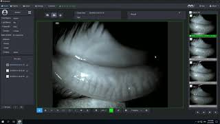 Meibomian Gland Analysis in Mediview [upl. by Aicnatsnoc307]