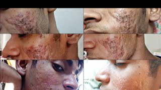 My Isotretinoin Journey 5 month on Accutane [upl. by Nerad704]