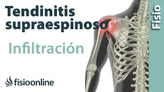 Tendinitis de hombro o supraespinoso infiltraciones [upl. by Anuahs]