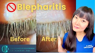 Best Blepharitis Treatments at Home  Simple amp Effective  Step by Step Guide Eye Surgeon Explains [upl. by Adnar]