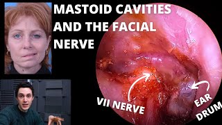 Mastoid Cavity Ear Surgery amp The Facial Nerve Explained [upl. by Orson22]