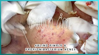 Big Cystic Acne Blackheads Extraction Blackheads amp Milia Whiteheads Removal Pimple Popping [upl. by Flosi]