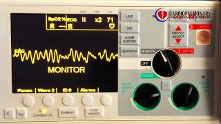 Fibrilación Ventricular en Monitor [upl. by Dolhenty]