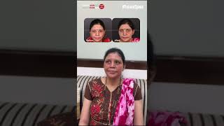 Acne Treatment That Works Deepalis Inspiring Story  Clear Skin Clinic Pune [upl. by Daisie90]