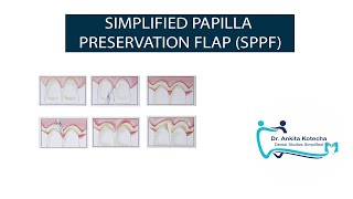 SIMPLIFIED PAPILLA PRESERVATION FLAP SPPFMINIMALLY INVASIVE PERIODONTAL SURGICAL TECHNIQUES [upl. by Ettevad711]