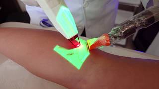 LASER PARA TRATAMENTO DE VASINHOS E VARIZES [upl. by Boyse]