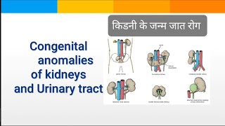 Congenital Anomalies of Kidneys  किडनी की जन्मजात बीमारी [upl. by Homer]