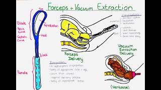 Forceps vs Vacuum Extraction Delivery Ventouse Understanding the Difference Procedures and Risks [upl. by Shurwood933]