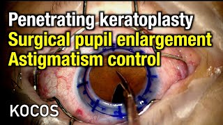 Penetrating keratoplasty surgical pupil enlargement astigmatism control [upl. by Norris]