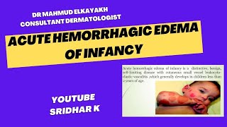 Acute hemorrhagic edemapurpuric rash and edema in baby rash newbornrash Acutehemorrhagicedema [upl. by Anirdnajela]