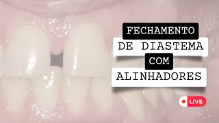 Fechamento de Diastema com Alinhadores [upl. by Clemmy571]