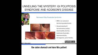 Unveiling the Mystery GI Polyposis Syndrome and Addisons Disease [upl. by Sigler]